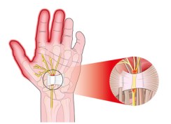 Double Crush and Carpal Tunnel Syndrome (CTS)